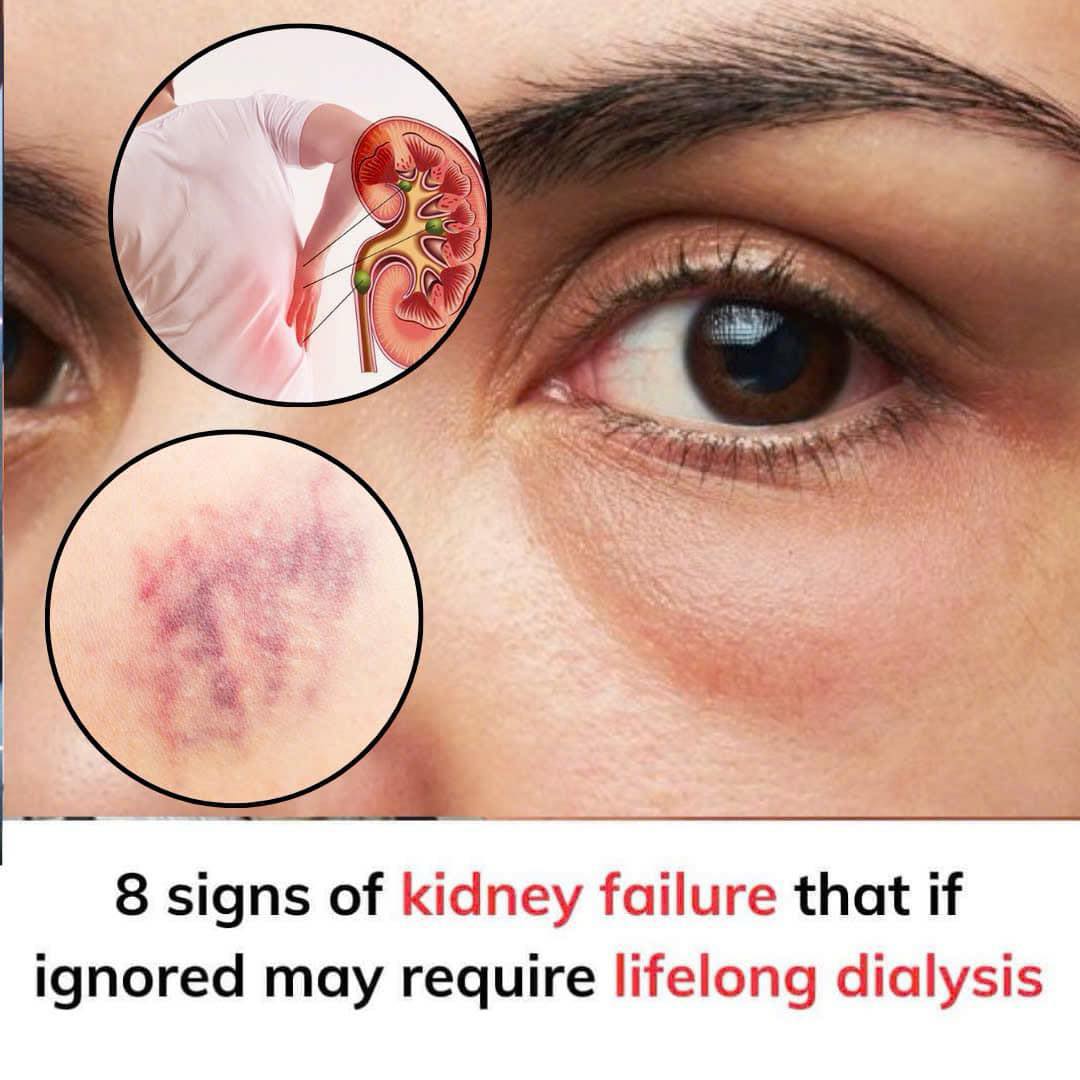 If Your Kidneys Are in Danger, the Body Will Show these 10 Signs
